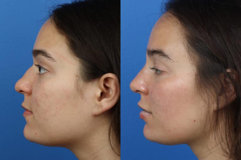 Rhinoplasty to Remove Dorsal Hump by Dr. Miller