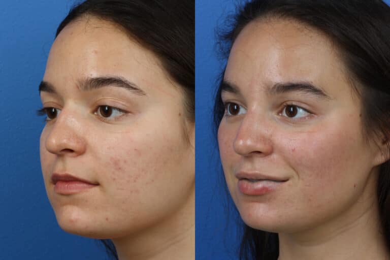 Rhinoplasty to Refine Nasal Bridge and Tip by Dr. Miller
