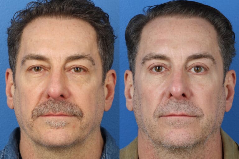 Upper and Lower Blepharoplasty to Rejuvenate the Eyes by Dr. Miller
