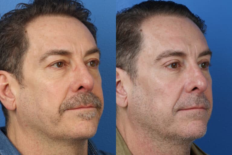 Upper and Lower Blepharoplasty to Rejuvenate Aging Eyes by Dr. Miller