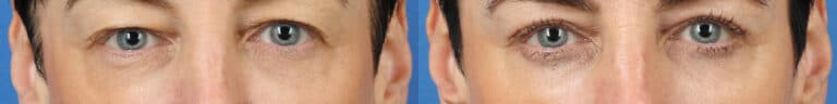 Blepharoplasty to Rejuvenate Eyes by Dr. Miller