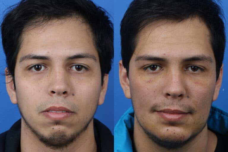 Chin Implant to Augment the Chin of a Male Patient by Dr. Miller