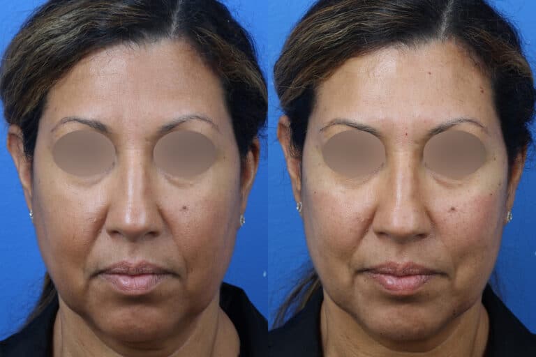 Cheek Filler to Augment the Cheeks of a Female Patient by Dr. Miller