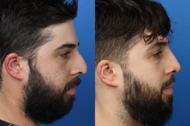 Rhinoplasty to Straighten Nasal Bridge by Dr. Miller