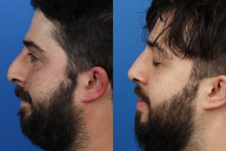 Rhinoplasty to Remove Hump from Nasal Bridge by Dr. Miller
