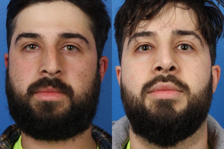 Rhinoplasty to Correct Nasal Bridge and Tip by Dr. Miller