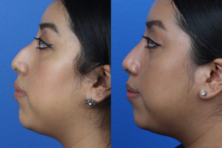 Rhinoplasty to Straighten the Nasal Bridge of a Female Patient by Dr. Miller