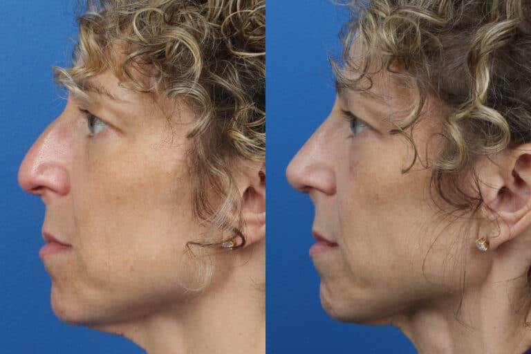 Rhinoplasty to Straighten Nasal Bridge by Dr. Miller