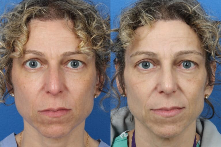 Rhinoplasty to Correct Dorsal Bridge by Dr. Miller