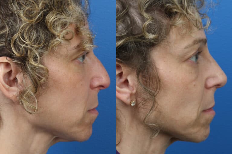 Rhinoplasty to Remove Hump from Nasal Bridge of a Female Patient by Dr. Miller