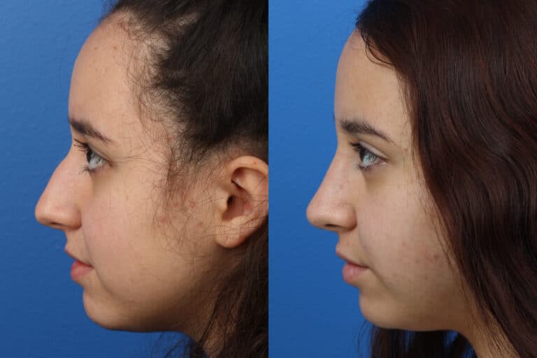 Rhinoplasty to Straighten the Bridge of a Female Patient by Dr. Miller