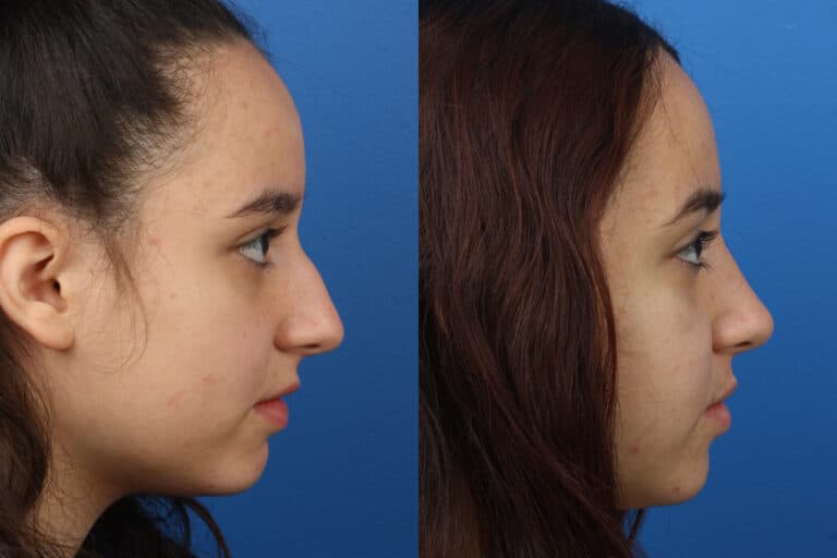 Rhinoplasty to Remove Hump from Nasal Bridge of a Female Patient by Dr. Miller