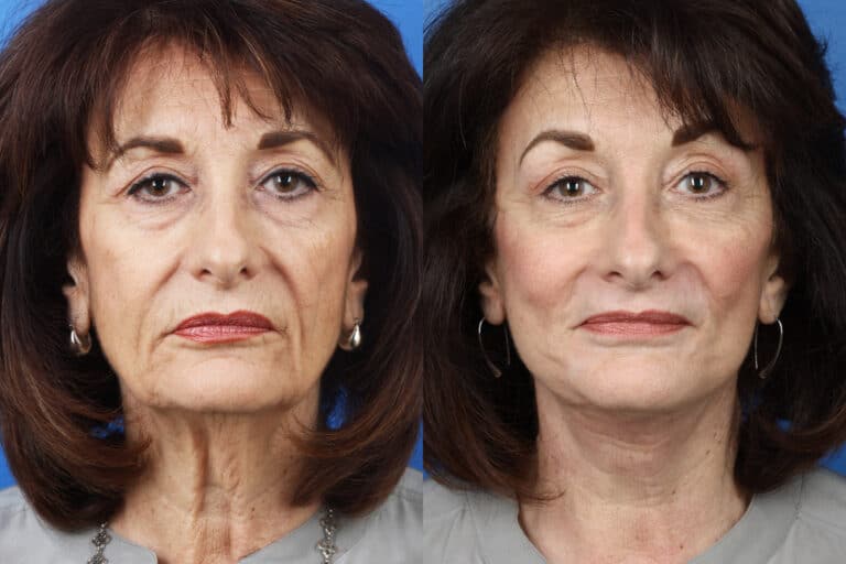 Facelift, Neck Lift, Dermabrasion and Earlobe Repair on a Female Patient by Dr. Miller