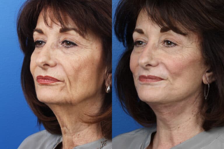 Facelift, Necklift and Dermabrasion to Rejuvenate the Skin by Dr. Miller