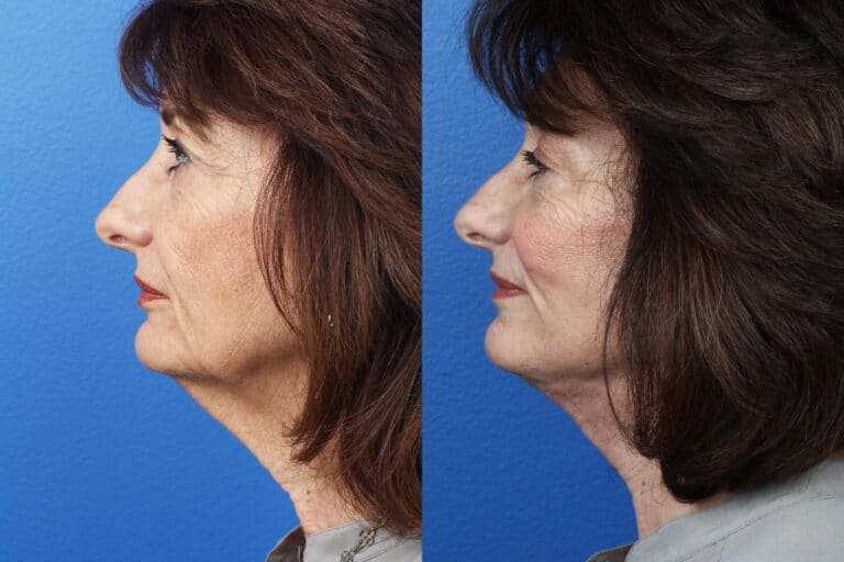 Facelift, Neck Lift, and Dermabrasion to Rejuvenate the Face of a Female Patient by Dr. Miller