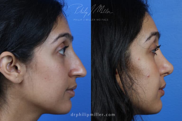 Rhinoplasty to Correct the Nasal Bridge on a Female Patient by Dr. Miller