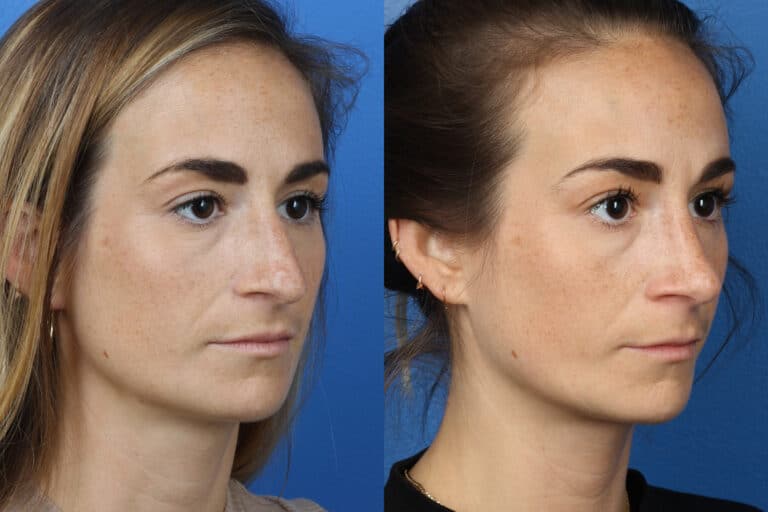 Rhinoplasty to remove hump from nasal bridge and refine the tip on a female patient by Dr. Miller