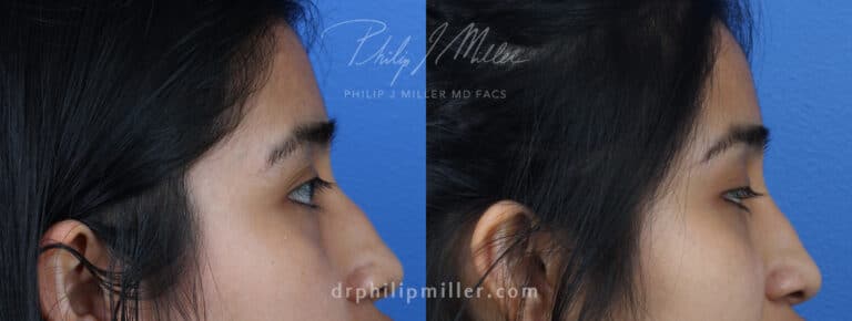 Rhinoplasty to Correct Nasal Bridge of a Female Patient by Dr. Miller