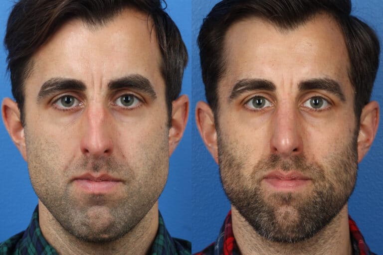 Rhinoplasty to Correct the Nasal Bridge of a Male Patient by Dr. Miller