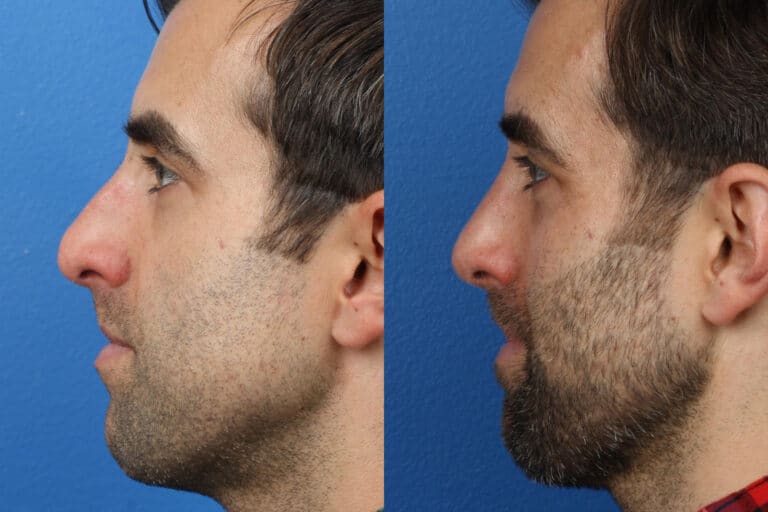 Rhinoplasty to Remove Bump from Nasal Bridge of a Male Patient by Dr. Miller