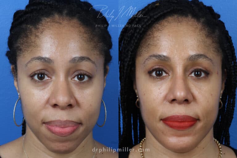 Rhinoplasty, Upper Blepharoplasty, Chin Implant, Fat Injections for Facial Contouring on a Female Patient by Dr. Miller