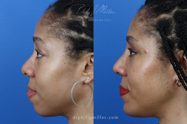 Rhinoplasty, Upper Blepharoplasty, Chin Implant, Fat Injections for Facial Contouring on a Female Patient by Dr. Miller