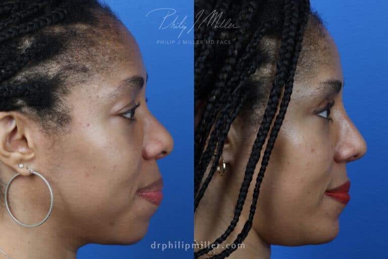 Rhinoplasty, Upper Blepharoplasty, Chin Implant, Fat Injections for Facial Contouring on a Female Patient by Dr. Miller