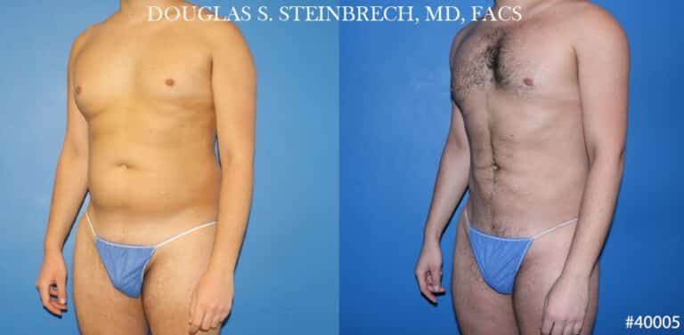 Body banking and liposuction to sculpt the midsection of a male patient by Dr. Steinbrech