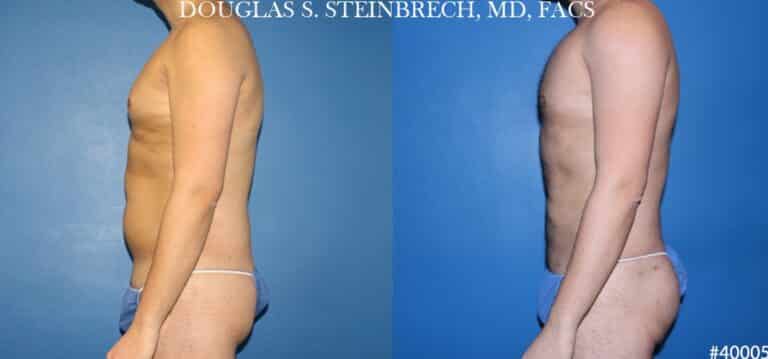 Body banking and liposuction to sculpt the midsection of a male patient by Dr. Steinbrech