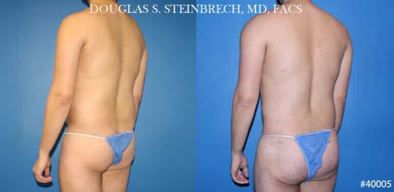 Body banking and liposuction to sculpt the back and buttocks of a male patient by Dr. Steinbrech