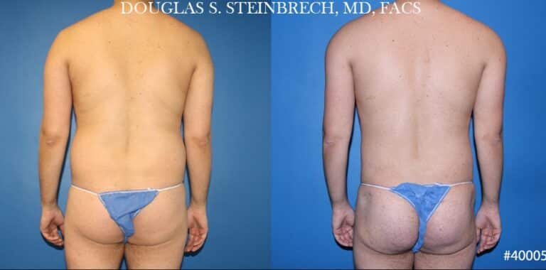 Body banking and liposuction to sculpt the back and buttocks of a male patient by Dr. Steinbrech