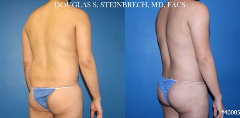 Body banking and liposuction to sculpt the back and buttocks of a male patient by Dr. Steinbrech