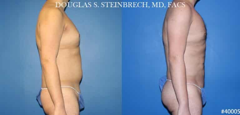 Body banking and liposuction to sculpt the midsection of a male patient by Dr. Steinbrech