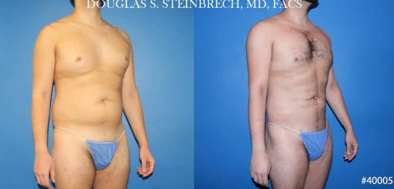 Body banking and liposuction to sculpt the midsection of a male patient by Dr. Steinbrech