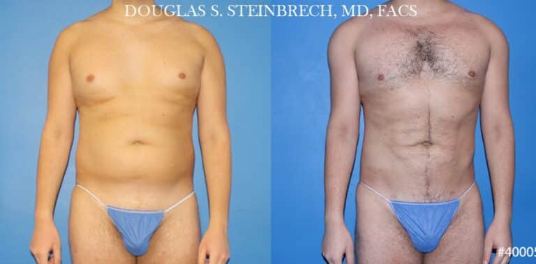 Body banking and liposuction to sculpt the midsection of a male patient by Dr. Steinbrech