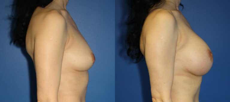 Breast implants to increase breast size by Dr. Steinbrech