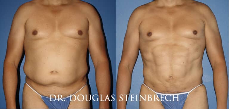Torso Tuck to reduce and sculpt the midsection by Dr. Steinbrech