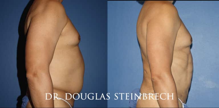 Torso Tuck to reduce and sculpt the midsection by Dr. Steinbrech