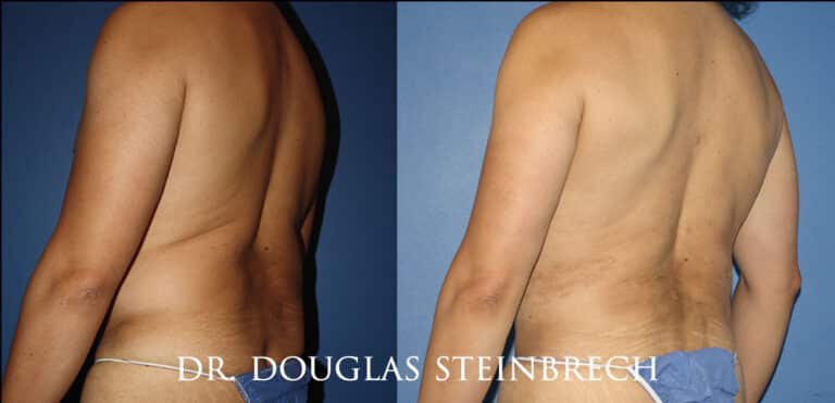 Torso Tuck to reduce and sculpt the back and midsection by Dr. Steinbrech