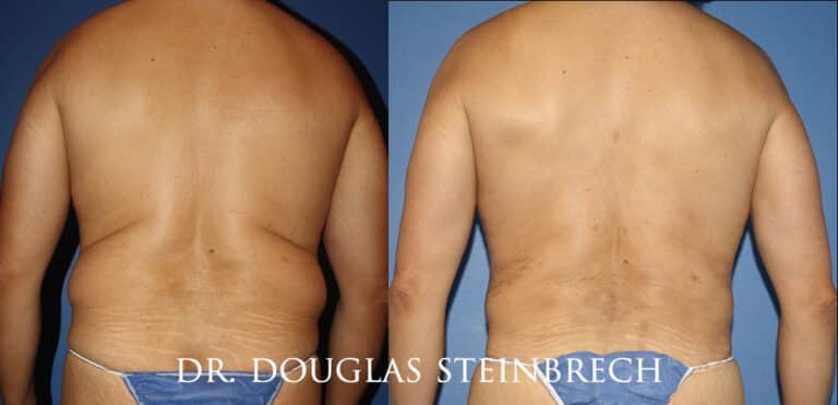 Torso Tuck to reduce and sculpt the back and waistline by Dr. Steinbrech