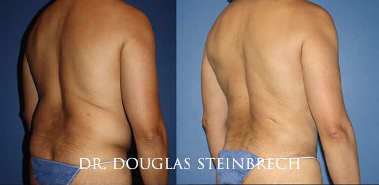 Torso Tuck to reduce and sculpt the back and midsection by Dr. Steinbrech