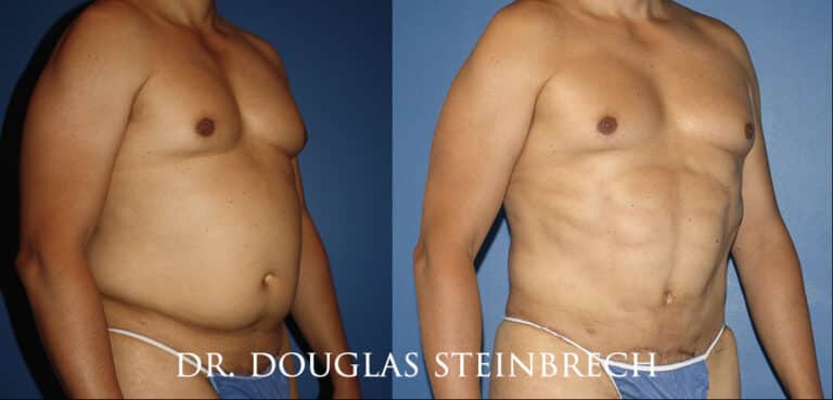 Torso Tuck to reduce and sculpt the midsection by Dr. Steinbrech