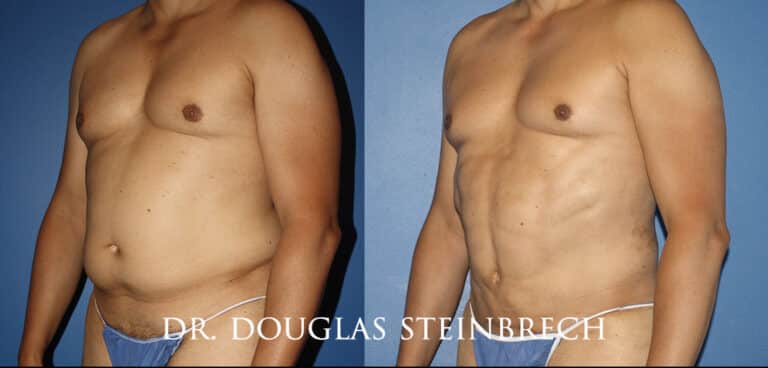 Torso Tuck to reduce and sculpt the midsection by Dr. Steinbrech