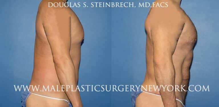 270 Torso tuck for abdominal sculpting by Dr. Steinbrech