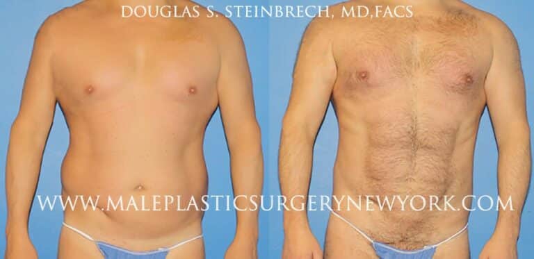 270 Torso tuck for abdominal sculpting by Dr. Steinbrech
