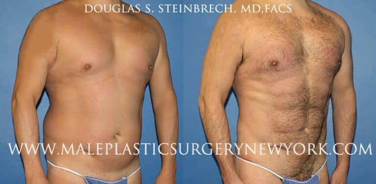 270 Torso tuck for abdominal sculpting by Dr. Steinbrech