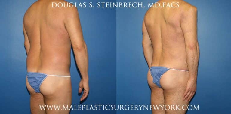 270 Torso tuck for abdominal sculpting by Dr. Steinbrech