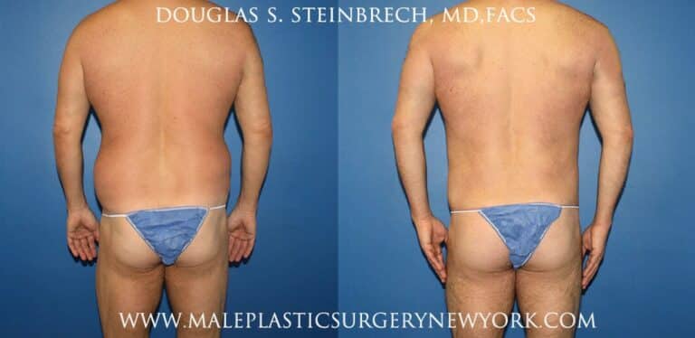 270 Torso tuck for abdominal sculpting by Dr. Steinbrech