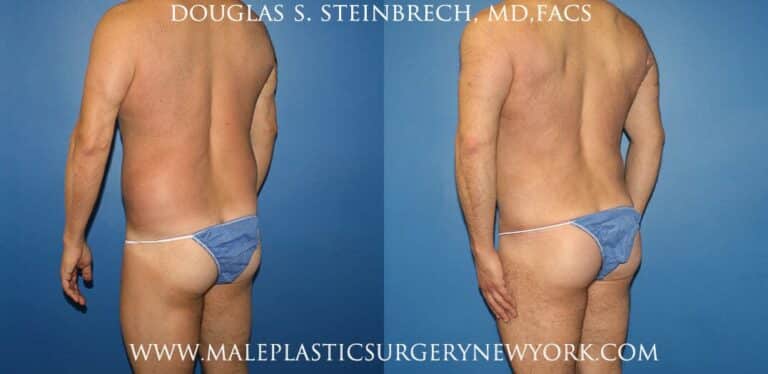 270 Torso tuck for abdominal sculpting by Dr. Steinbrech