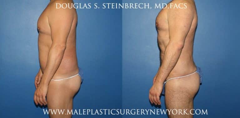 270 Torso tuck for abdominal sculpting by Dr. Steinbrech